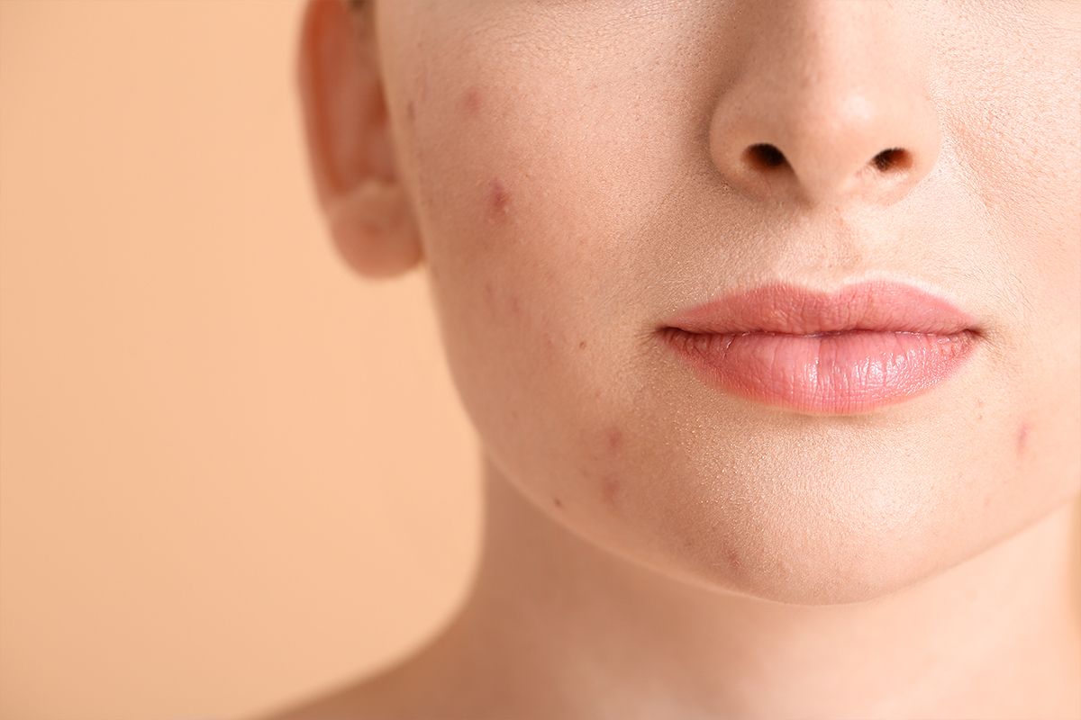Azelaic acid for acne