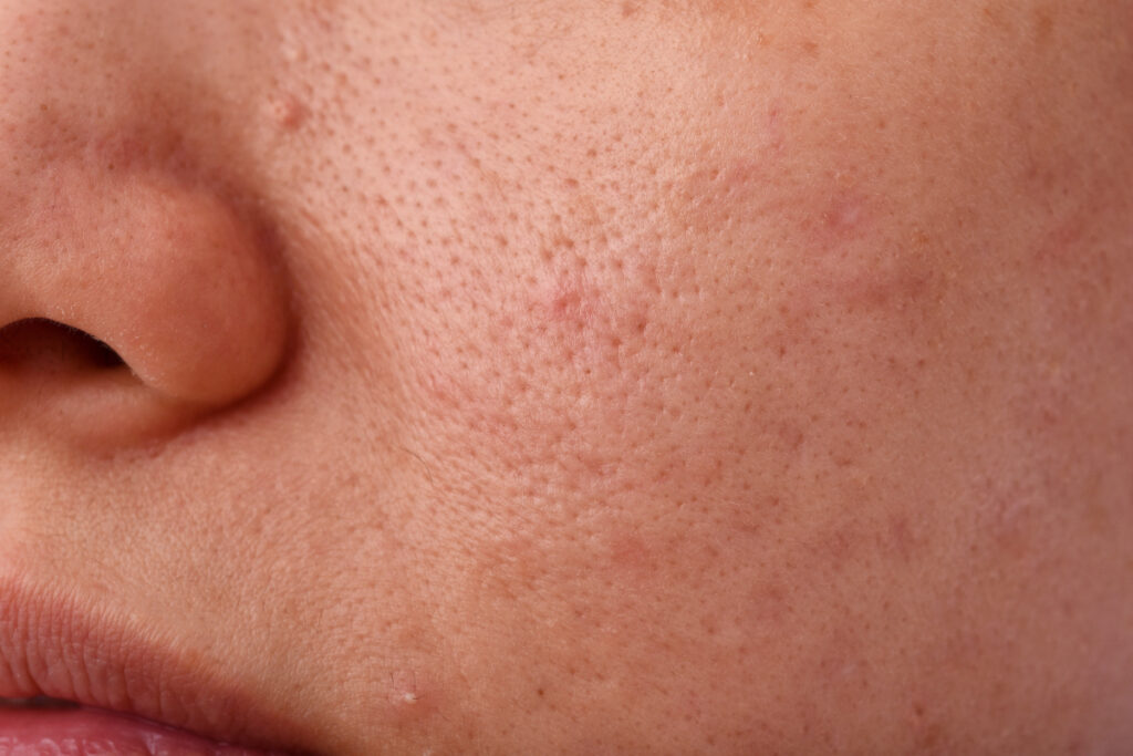 Masna koža lica sa bubuljicama
