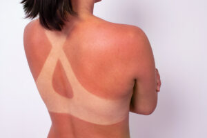 Sunburns: How to Avoid and Cure Them
